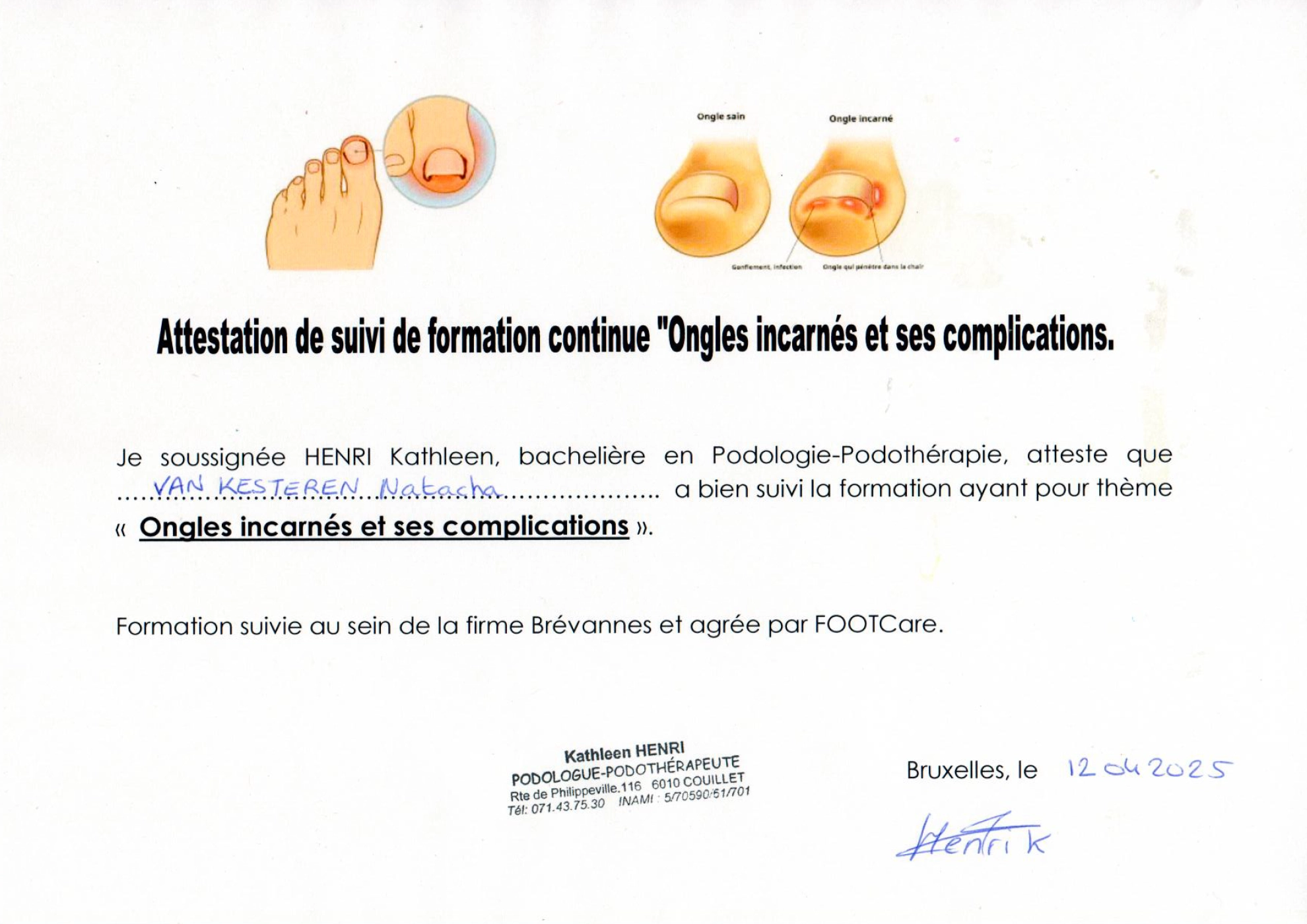 Ongle incarné et complication